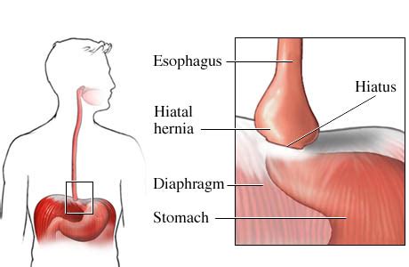 » Symptoms of Hiatal Hernia; Hiatal Hernia Symptoms and Treatment Options