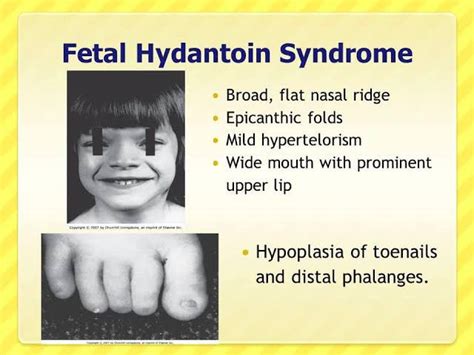 These are the symptoms of Fetal Hydantoin syndrome - MEDizzy