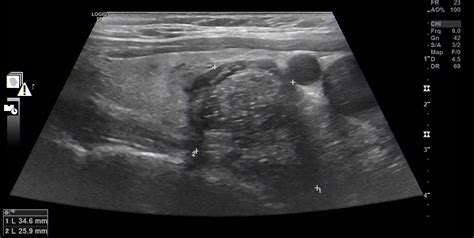 Thyroid teratoma – a challenging diagnosis of a thyroid nodule | Eurorad