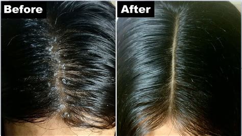 Dandruff Treatment - Unah