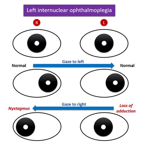 INTERNUCLEAR OPHTHALMOPLEGIA PDF