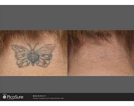 PicoSure Tattoo Removal Before and After Photos - Orange Coast Aesthetics