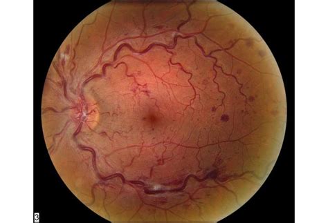 Central Retinal Vein Occlusion – Mid Atlantic Retina