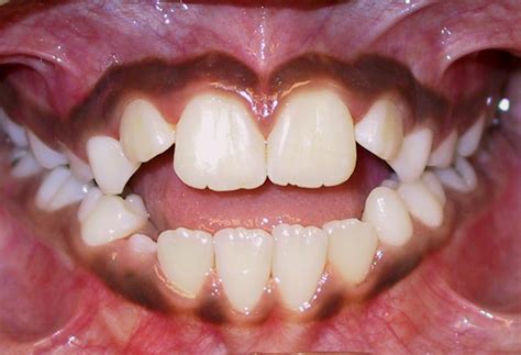 What is tongue thrust and why is it a problem? | News | Dentagama