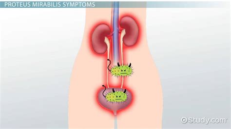 Proteus Mirabilis Infection: Causes, Symptoms & Treatment - Video ...