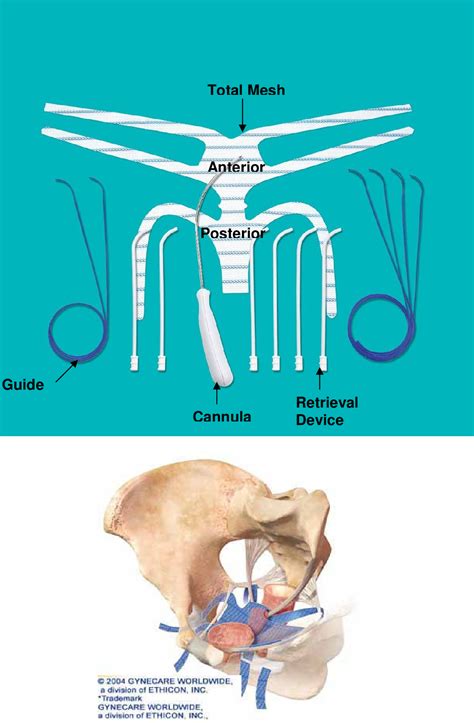 Figure 3 from Vaginal Mesh Kits for Pelvic Organ Prolapse, Friend or Foe: A Comprehensive Review ...