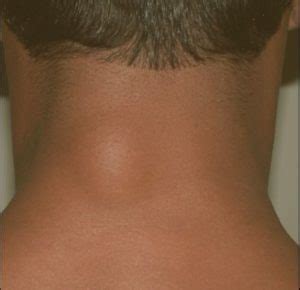 Lump on Back of Neck, Hairline, under Skin, Right Side, Left, Near Spine, Hurts, Soft, Hard ...