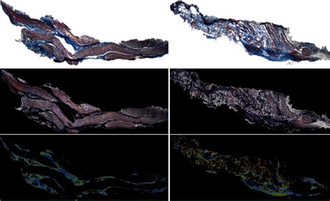 Histological neuroma image example [Herrera-Rincon, 2011]. Top: images ...