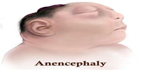 Anencephaly - Assignment Point