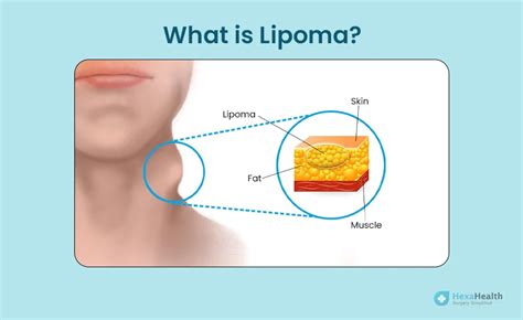 Lipoma - Meaning, Causes, Symptoms, Pictures & Types