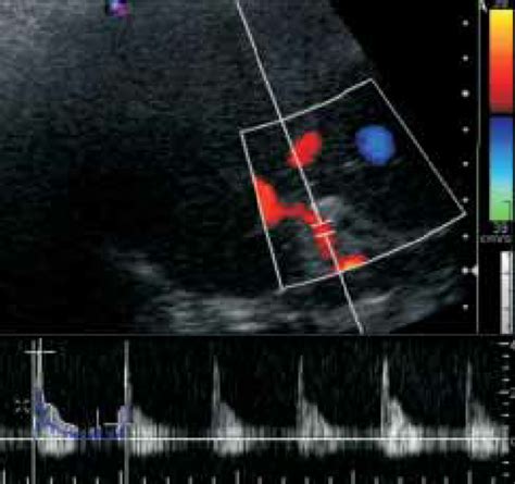 Color Doppler ultrasound 24 hrs after the OLT, showing a hepatic artery ...