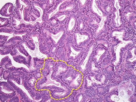 15.Female genital organs (5) Complex endometrial hyperplasia|Pathology Core Pictures