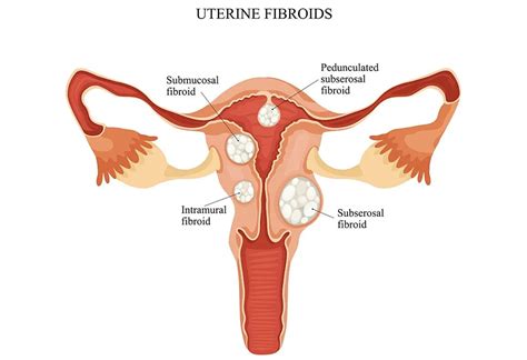 Uterine Fibroids: Reasons, Signs & Treatment