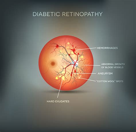 Diabetic Retinopathy Treatment - Grosinger, Spigelman & Grey