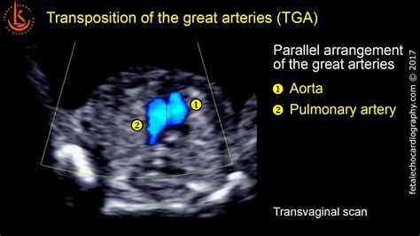 Fetal echocardiography at 11-13 weeks: Transposition of the Great Arteries (TGA) - YouTube