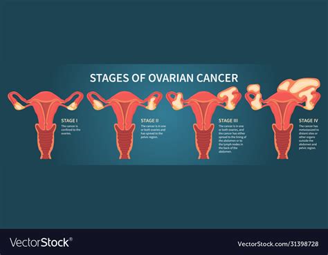 Four stages ovarian cancer dark blue scheme Vector Image