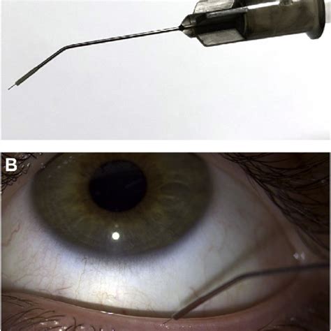 e Meibography of (A) healthy meibomian glands, (B) MGD with moderate... | Download Scientific ...