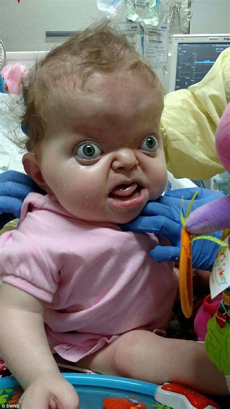 Moment a 19-month-old girl with Apert syndrome sits up by herself | Daily Mail Online