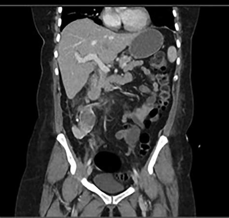 Progress CT showed worsening of perinephric inflammatory stranding and... | Download Scientific ...