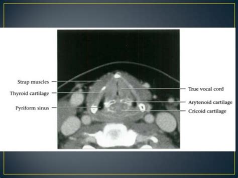 Larynx anatomy ct and mri