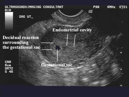 Uterine Cavity Ultrasound