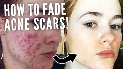 How Long Does It Take For Acne Scars To Fade - How To Discuss