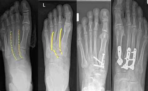 Lisfranc fracture dislocation: a review of a commonly missed injury of the midfoot | Emergency ...