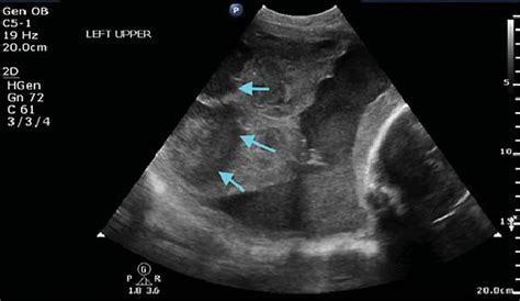 Fundal Placenta Ultrasound