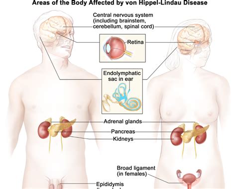 Von Hippel Lindau (VHL) Clinic at UFHealth » Department of Neurology ...