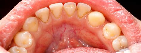 The Two Types of Harmful Bacteria in The Mouth | Implant & Perio Center of Kansas