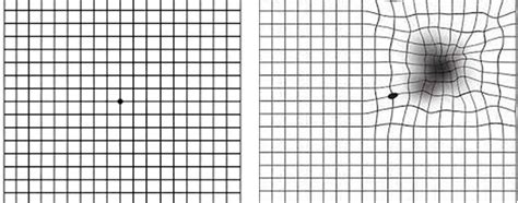 Wet Age-related Macular Degeneration (Wet AMD) Article