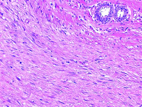 Pathology Outlines - Fibromatosis