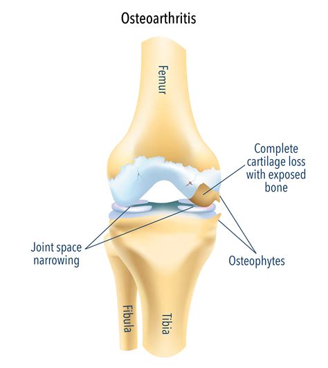 Knee Osteoarthritis Treatment & Surgery | Osteoarthritis Knee Replacement