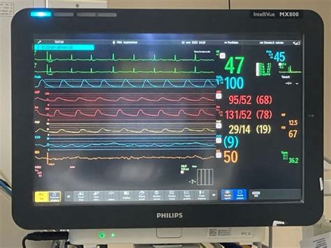 Perioperative Hemodynamic Monitoring - European Association of Cardiothoracic Anaesthesiology ...