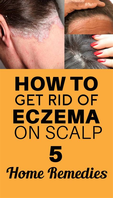 Have you ever heard about #eczemaonscalp? If your answer is no, then ...