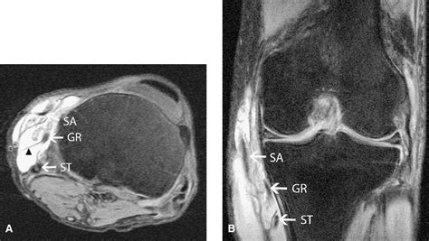 Figure 3 from Pes anserine bursitis - an extra-articular manifestation of gout. | Semantic Scholar