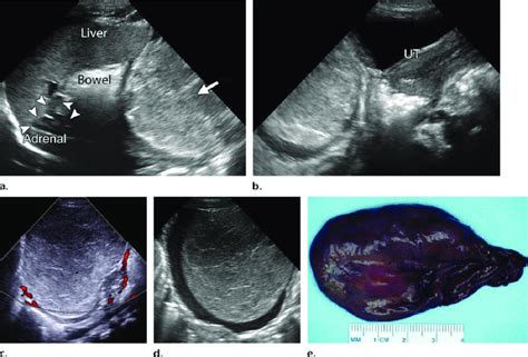 Hemorrhagic infarction causing a solid appearance in an ovarian cyst.... | Download Scientific ...