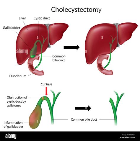 Cholecystectomy Anatomy