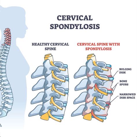 Cervical spondylosis: Causes, Risk Factors, Symptoms, Treatment