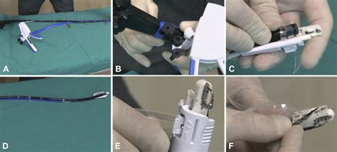 Step-by-step approach to endoscopic gastroplasty by a novel single-channel endoscopic suturing ...