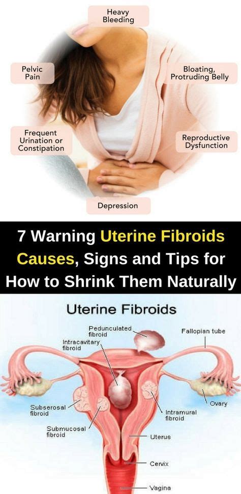 Here Are 7 Warning Uterine Fibroids Causes, Signs & Tips For How To ...