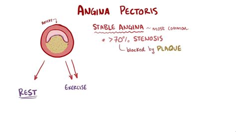 Stable Vs Unstable Angina Vs Mi - Percutaneous Coronary Intervention In ...