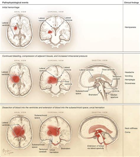 Hemorrhagic stroke, Ischemic stroke, Patient