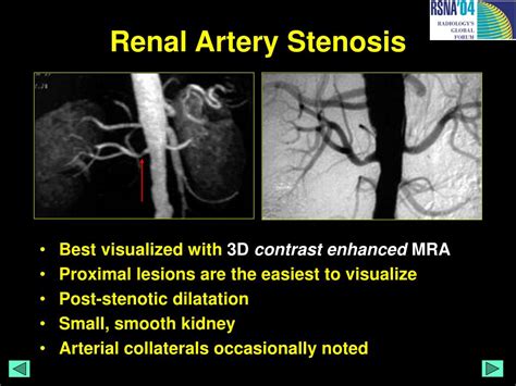 PPT - MRI Atlas of Renal Pathology PowerPoint Presentation - ID:377337