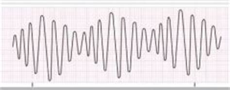 EKG rhythm strips quiz Flashcards - Cram.com