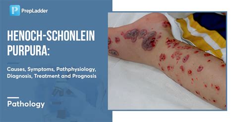 Henoch-Schonlein Purpura: Causes, Symptoms, Treatment & Prognosis