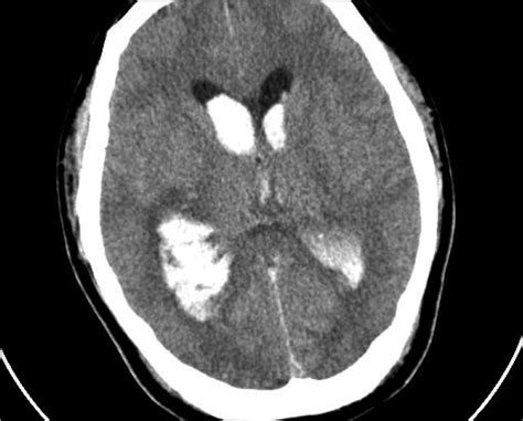 Intraventricular Hemorrhage Adult