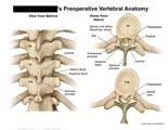 AMICUS Illustration of amicus,anatomy,vertebral,vertebrae,thoracic,spine,preoperative,lamina ...