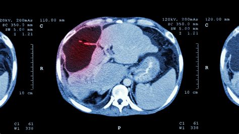 Hemangioma Liver Lesions