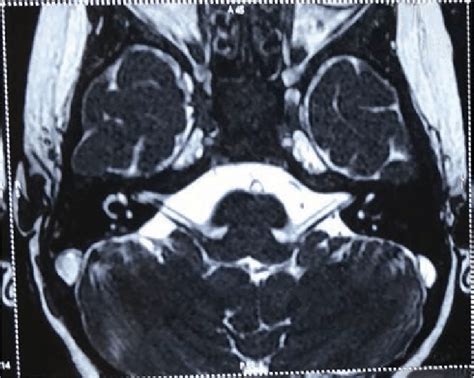 Cranial Nerve 6 Mri